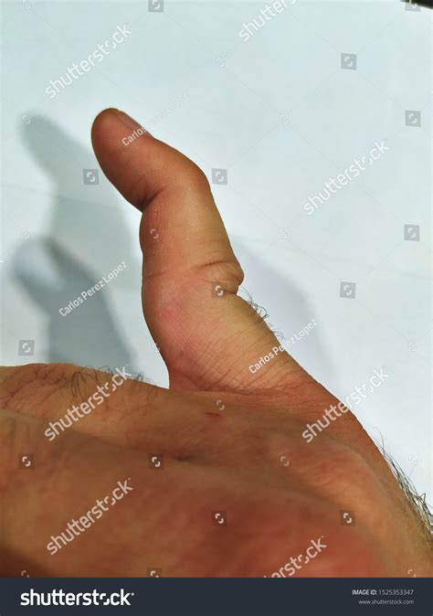 Dislocated Pinky Finger