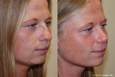 Eric M. Joseph, MD | Rhinoplasty Before & After: Deviated Septum Correction