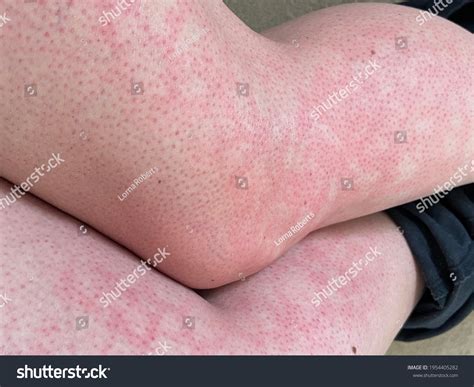 Mottled Skin Heat Rash Hives Allergy库存照片1954405282 | Shutterstock