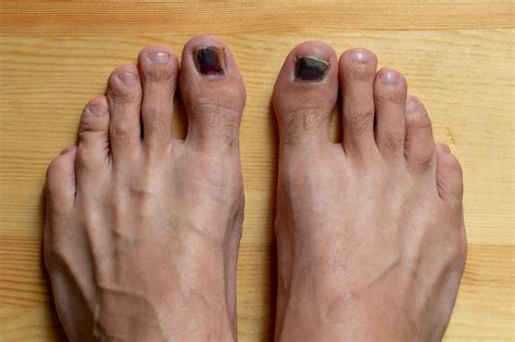 Black Toenail Fungus: 10 Signs, Causes & Best Treatments