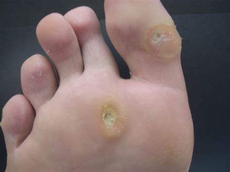 Plantar Wart On Big Toe Removal at Victoria Mcbrien blog