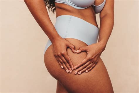 Lipedema on the legs: How do I recognize lipedema?