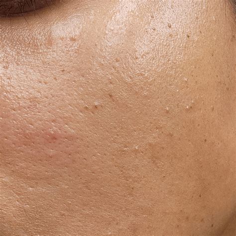 Help: Tiny bumps all over face : r/SkincareAddicts