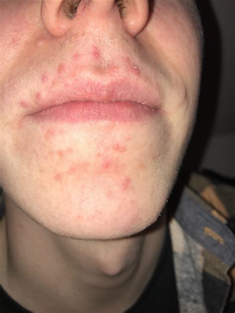 Hormonal Acne Around Mouth