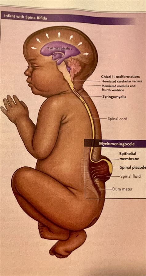 Spina Bifida Occulta Dimple