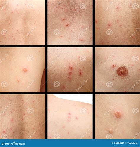 List 99+ Pictures Photos Of Chicken Poxs Full HD, 2k, 4k