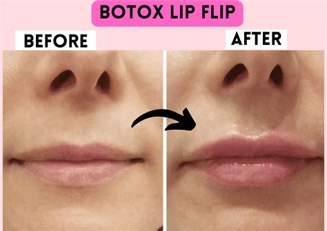 Botox Lip Flip Side Effects - the daily glimmer