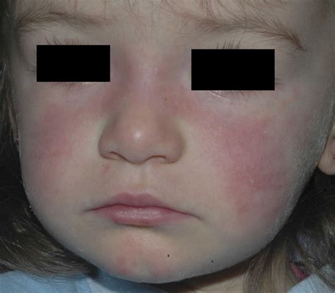 Pediatric lupus causes, symptoms, diagnosis, treatment & prognosis