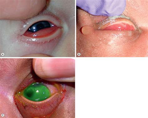Conjunctivitis of the newborn - Clinical Tree