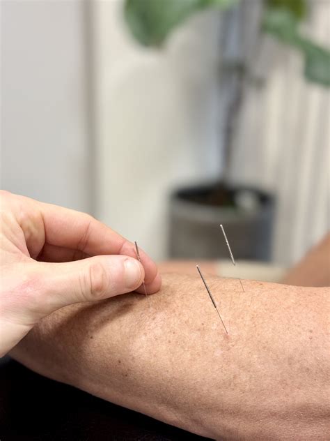 Dry Needling Explained: What It Is and How It Helps Muscle Pain | Pure Physio