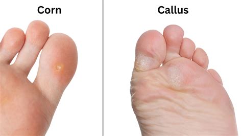 Corn & Callus: Symptoms, Causes & Treatments in Singapore
