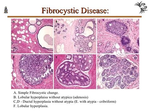 PPT - Pathology of Breast Disorders PowerPoint Presentation, free download - ID:8201844