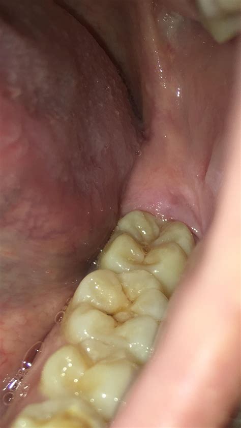 A lot of pain,dentist said my wisdom teeth don't seem to be coming in,will go there again next ...