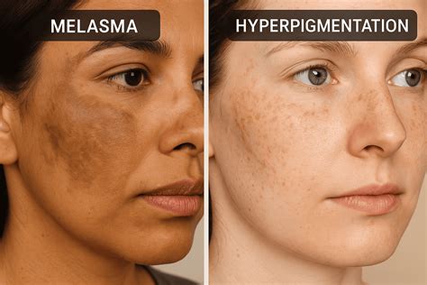 Melasma Vs Hyperpigmentation: Understanding The Difference & Treatment ...