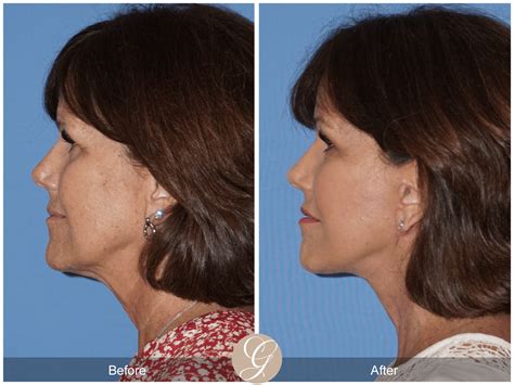 What is SMAS? Understand Your Facelift and Neck Lift Procedure