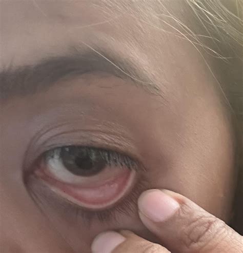 Do i have a iron deficiency based on my eyelids? : r/Philippines