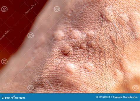The Lesion on Foot after Caused by Ants Bites Red Imported Fire Ant ...