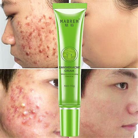 Crema eficaz para eliminar el acné, tratamiento para el cuidado de manchas de cicatrices de acné ...