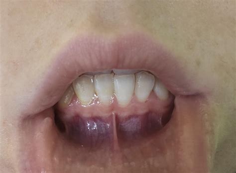 Purple Colored Gums