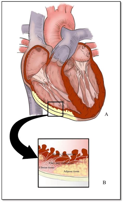 Cardiopatia Arritmogenica Do Ventriculo Direito - RETOEDU