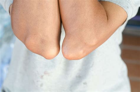 Why Your Elbows Develop Bumps and How to Treat Them