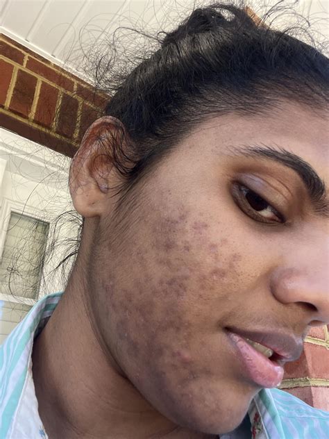Will this hyperpigmentation ever fade or am I doomed? : r/Sephora