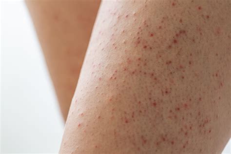 Keratosis Pilaris - Armoraa