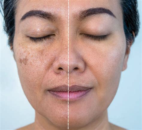 BeautyPlus - Pigmentatie