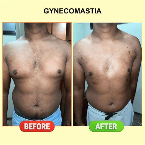 Chest Fat After Gynecomastia Surgery at Pauline Dane blog
