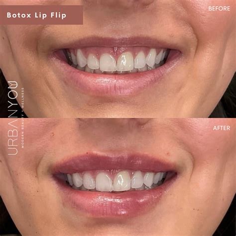 Botox Lip Flip | Before and After | Botox lips, Botox, Lip fillers
