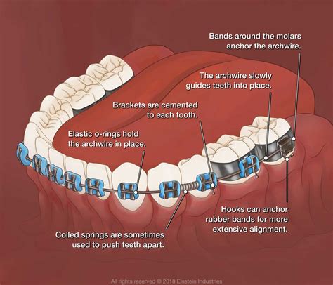How Do Braces Work – Stephenson Orthodontics Blog