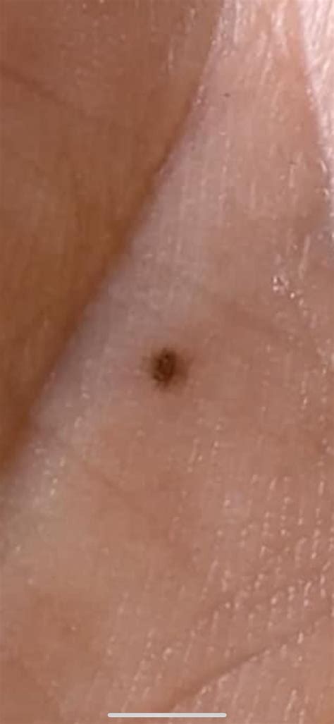 Mole or freckle on palm? : r/Melanoma