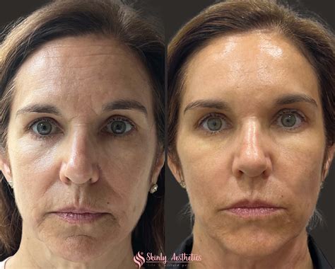 Cheek Fillers - Before & After Results at Skinly
