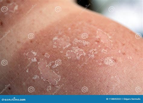 Peeling Skin At Back And Shoulder From Sunburn Effect Royalty-Free Stock Photo | CartoonDealer ...