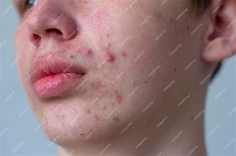 A picture of acne on the face of a teenager pimples red scars and black dots on cheeks and chin ...