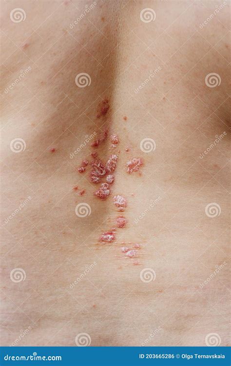 Back View of Woman with Dermatitis Problem of Rash and Itchy Dry Skin. Stock Photo - Image of ...