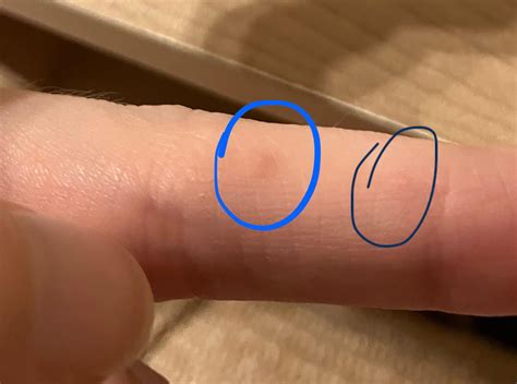 Small, painful bumps (blisters?) on fingers - derm says it’s allergies but I’m not convinced ...