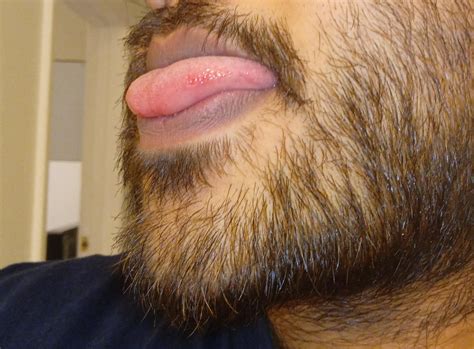 what are these red bumps on side of tongue? : r/askdentists