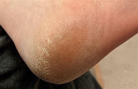 [Skin Concerns] Is this dry skin, seb-derm, or athlete's foot? : r/SkincareAddiction