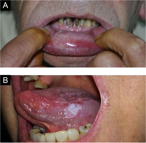 Linea Alba Tongue Oral Lesions
