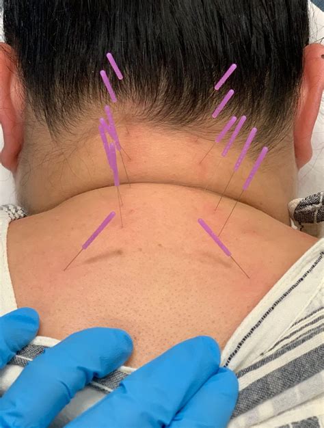 How does Dry Needling Work? - Mission Rehabilitation & Sports Medicine
