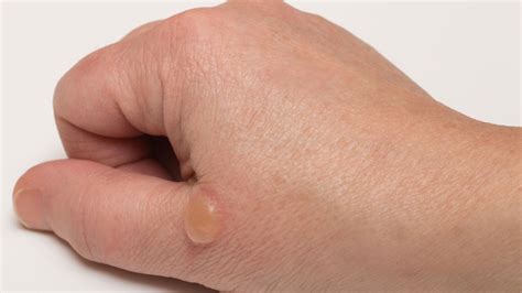 What are the Causes, Symptoms, and Treatment of Blood Blisters?