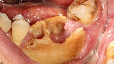 Osteoradionecrosis Of Jaw