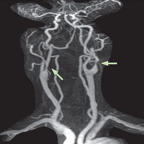 Carotid-artery imaging in the diagnosis and management of patients at ...