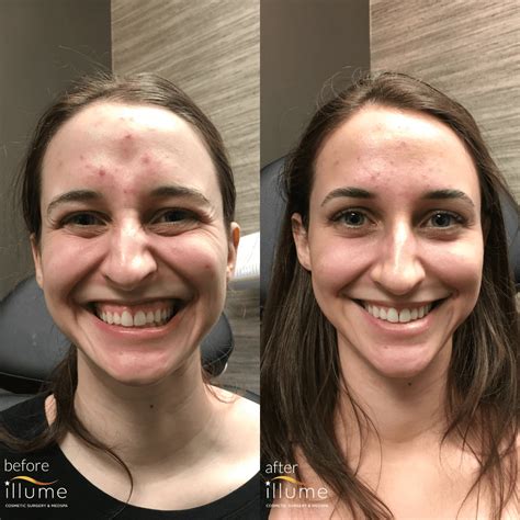 Lip Flip Botox Toronto at Maria Baum blog