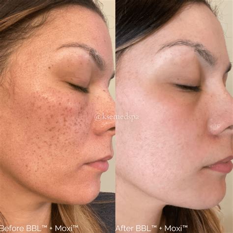BBL & Moxi – Total Skin Rejuvenation | Kingwood Skin Essentials