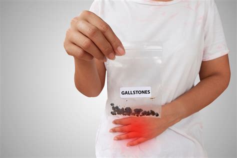 Passing Gallstones
