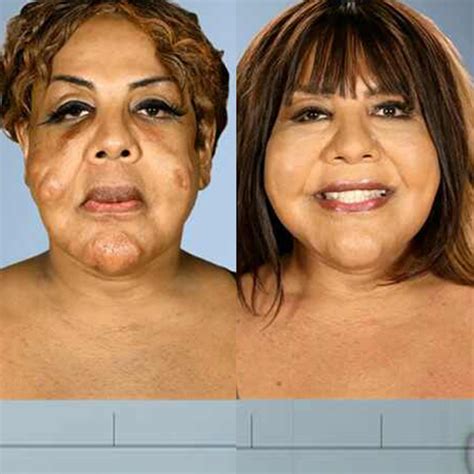 Botched Plastic Surgery Before and After Pics