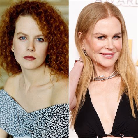 Nicole Kidman Surgery