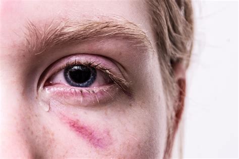 ¿Tienes un derrame en el ojo? Estas pueden ser sus causas
